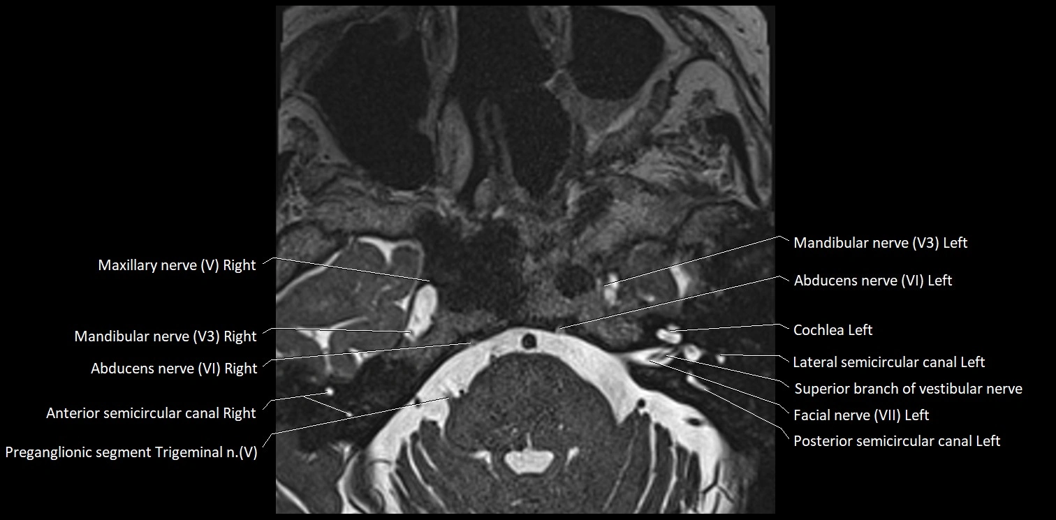 Cranial nerve anatomy axial MRI 3T image 48.webp